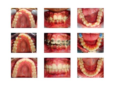 A collage of pictures of a person 's teeth with braces A collage of pictures of a person 's teeth with braces