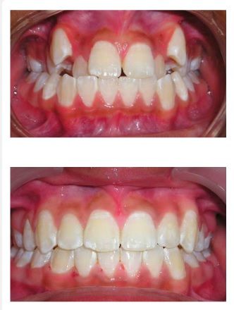 A before and after picture of a person 's teeth. A before and after picture of a person 's teeth.