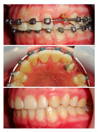 Three pictures of a person 's teeth with braces on them Three pictures of a person 's teeth with braces on them