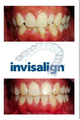 A picture of a person 's teeth before and after using invisalign. A picture of a person 's teeth before and after using invisalign.