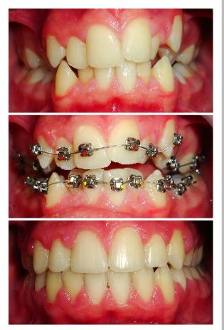 Three pictures of a person 's teeth with braces on them Three pictures of a person 's teeth with braces on them