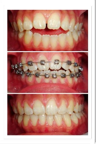 A collage of three pictures of a person 's teeth with braces. A collage of three pictures of a person 's teeth with braces.
