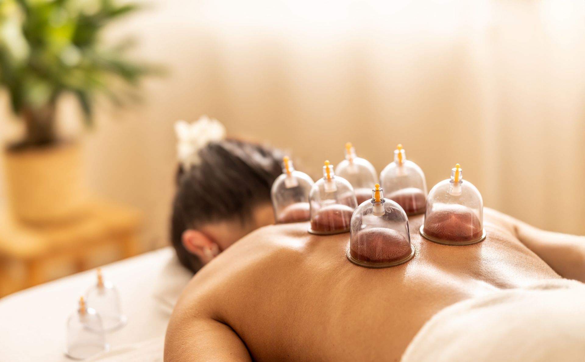 A woman is getting a cupping treatment on her back.