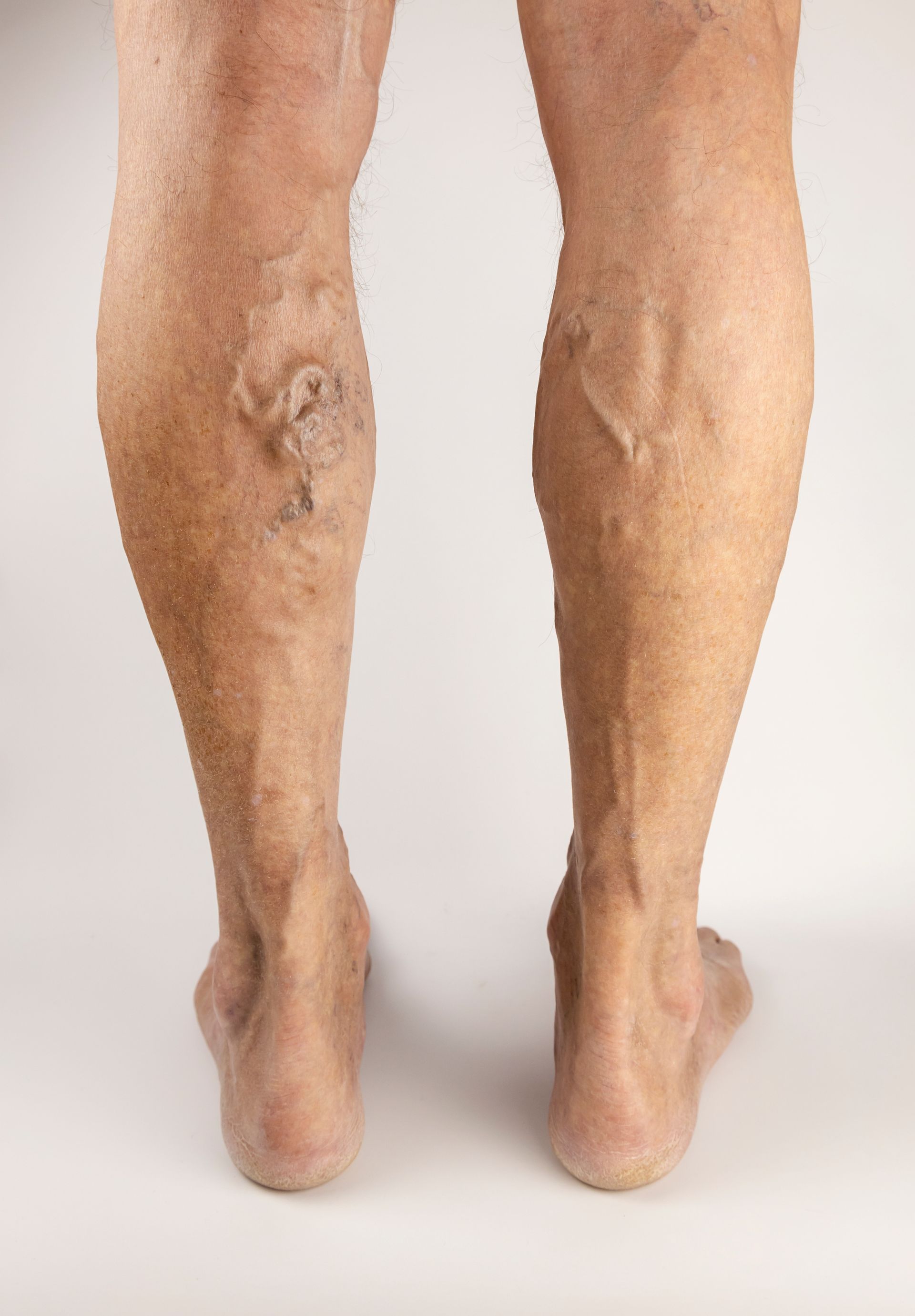 a close up of a person 's legs with varicose veins