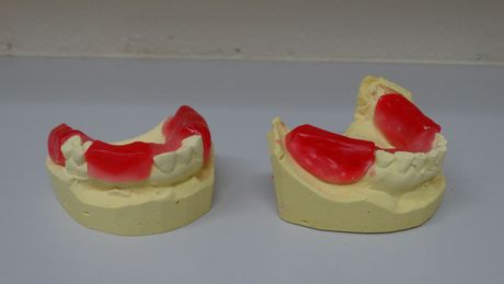 Partial Wax Bite — Batehaven, NSW — Keen Dentures