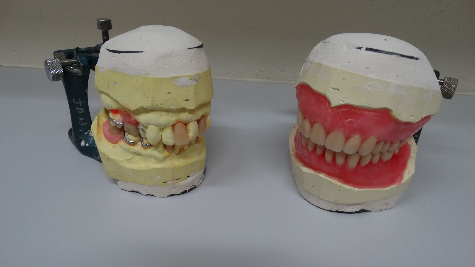 Partial and Full Wax Try-ins — Batehaven, NSW — Keen Dentures