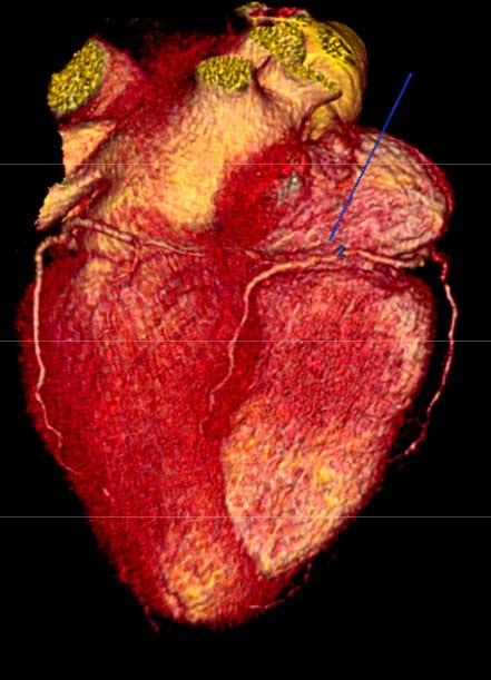 DRA. CYNTHIA ROMERO ARAGONÉS - Angina de pecho