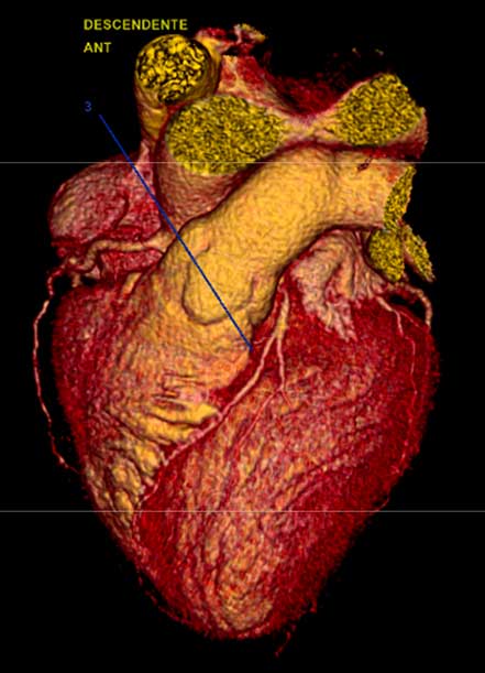 DRA. CYNTHIA ROMERO ARAGONÉS - Hipertensión arterial