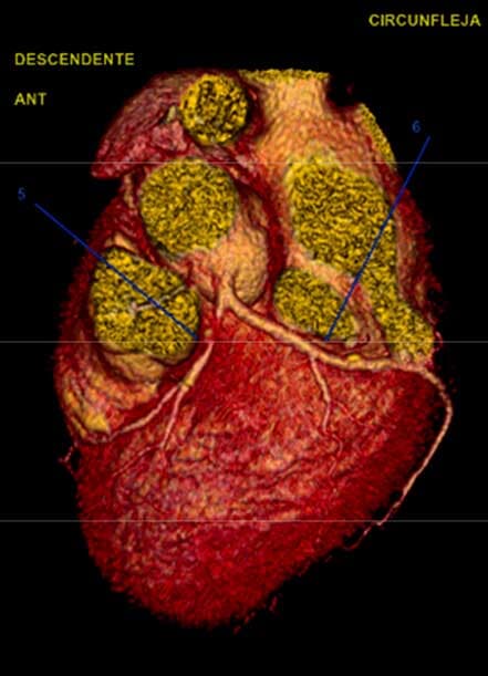 DRA. CYNTHIA ROMERO ARAGONÉS - Infarto
