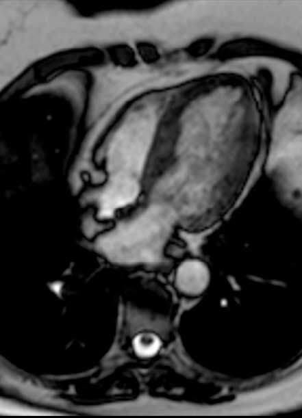 DRA. CYNTHIA ROMERO ARAGONÉS - Angiotomografía coronaria