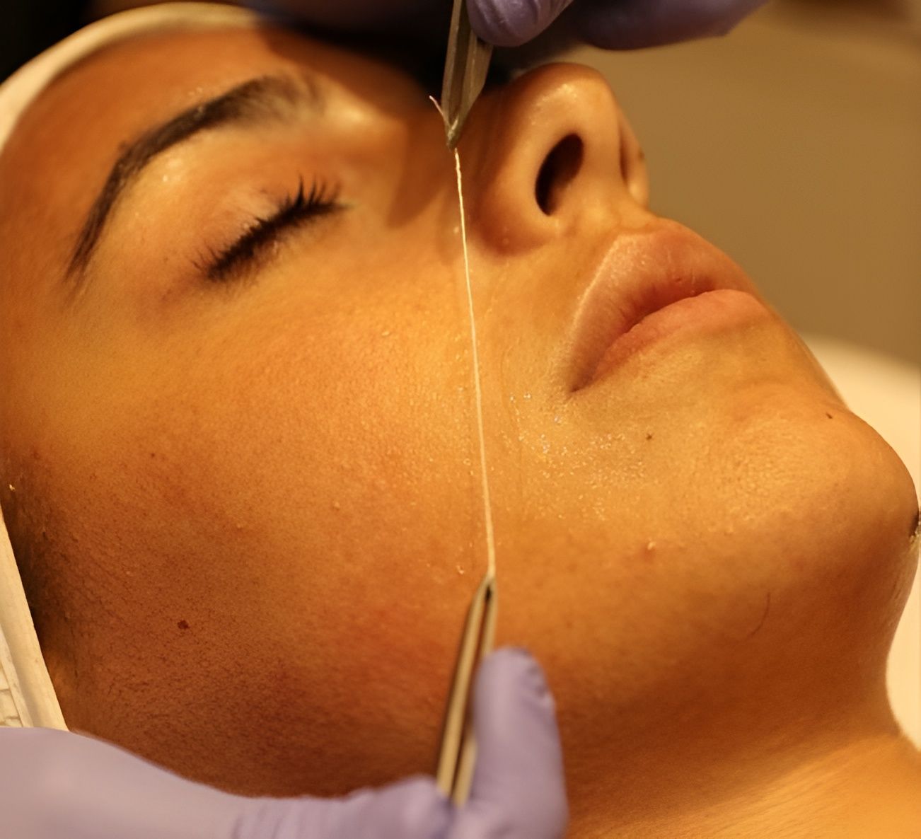 trattamenti fili collagene viso