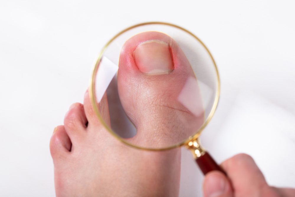 A Person Is Looking at A Toenail with A Magnifying Glass — Swan Podiatry and Orthotics in Coconut Grove, NT