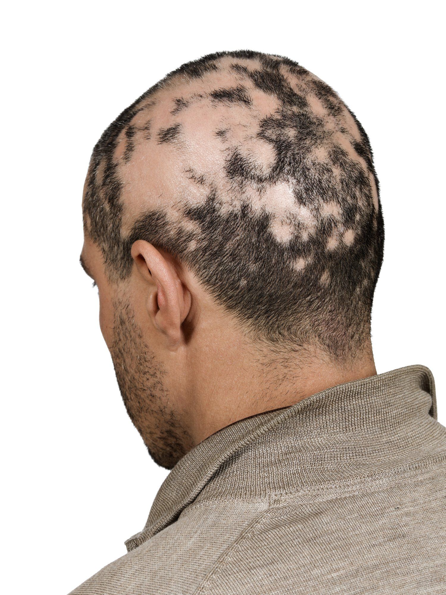 Почему воняет волосы. Очаговая (гнездная) алопеция. Очаговая алопеция (alopecia Areata).