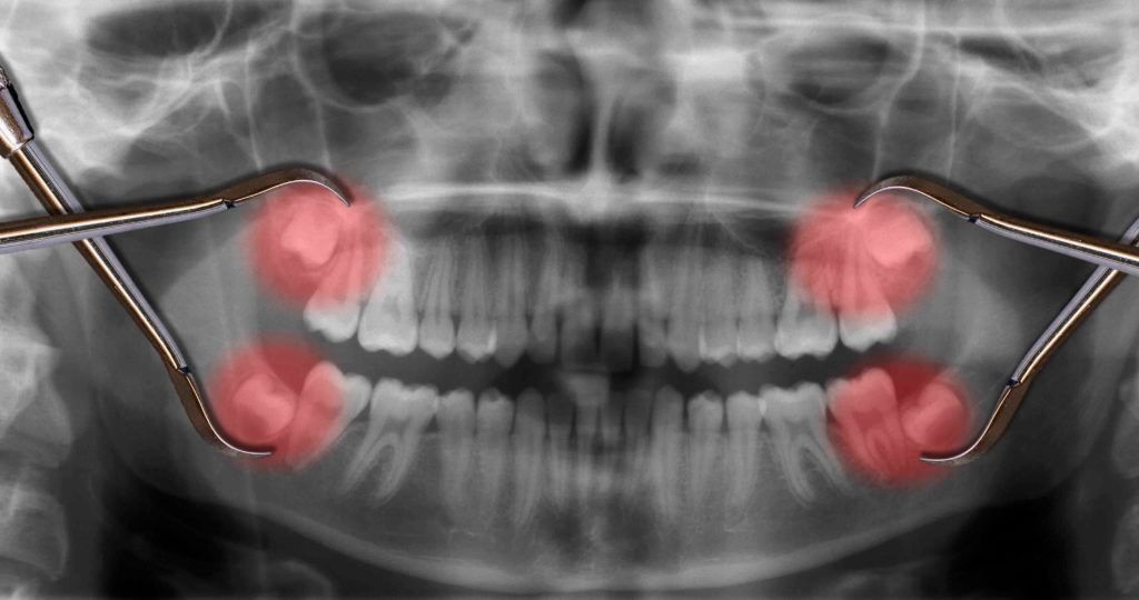 wisdom teeth dental xray with dental tools for extractions | Morgantown WV