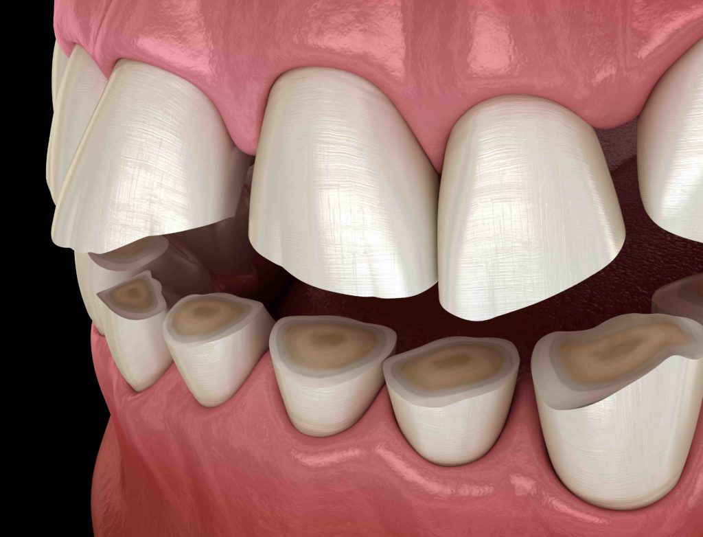 Impact of teeth grinding | image graphic recreation | family dentist Morgantown WV