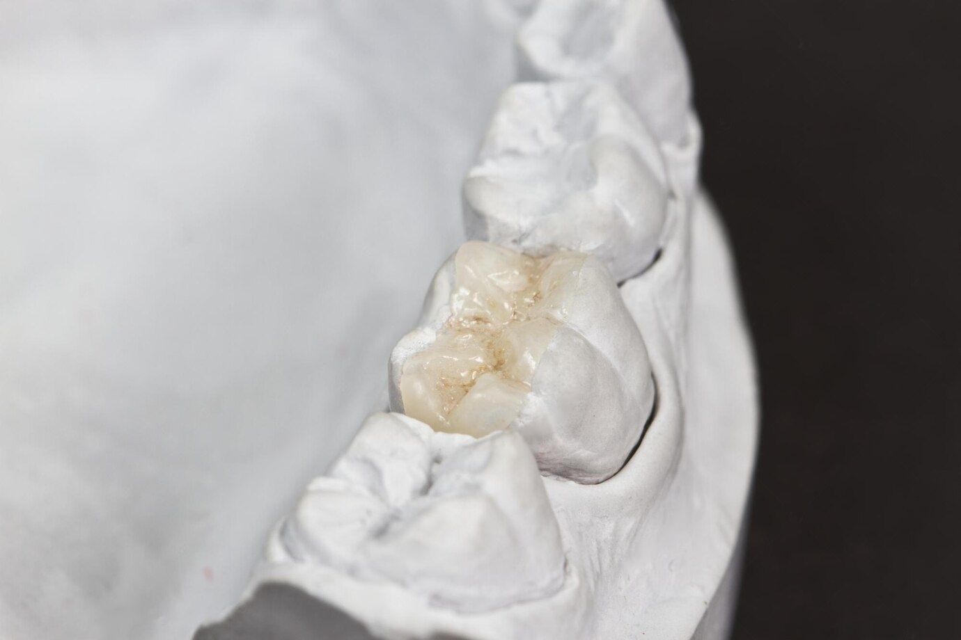 Dental Onlays Image | Best Biodentist Morgantown WV