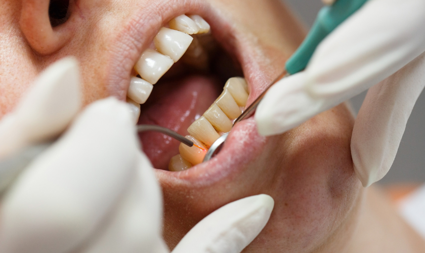 A person's mouth open during a dental cleaning. Gloved hands hold tools near the teeth and gums.