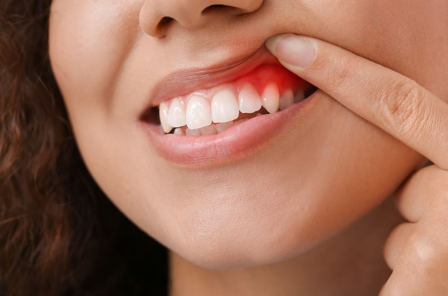Gum diseases and what causes it | Woman with red gums | Pain | Morgantown WV Dentist
