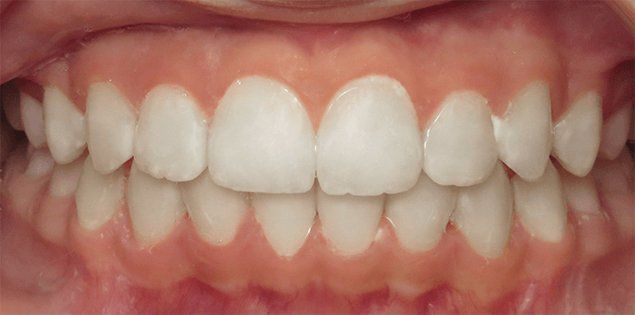 Invisalign, Clear Aligners, North Vancouver