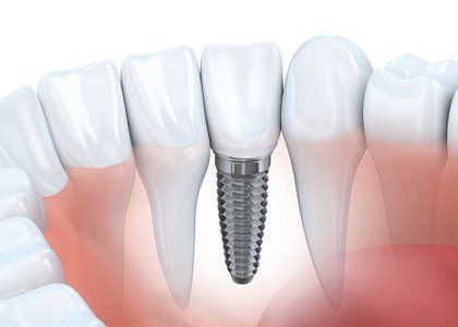 Dental Implant - Cosmetic Dentistry in Pleasantville, NJ