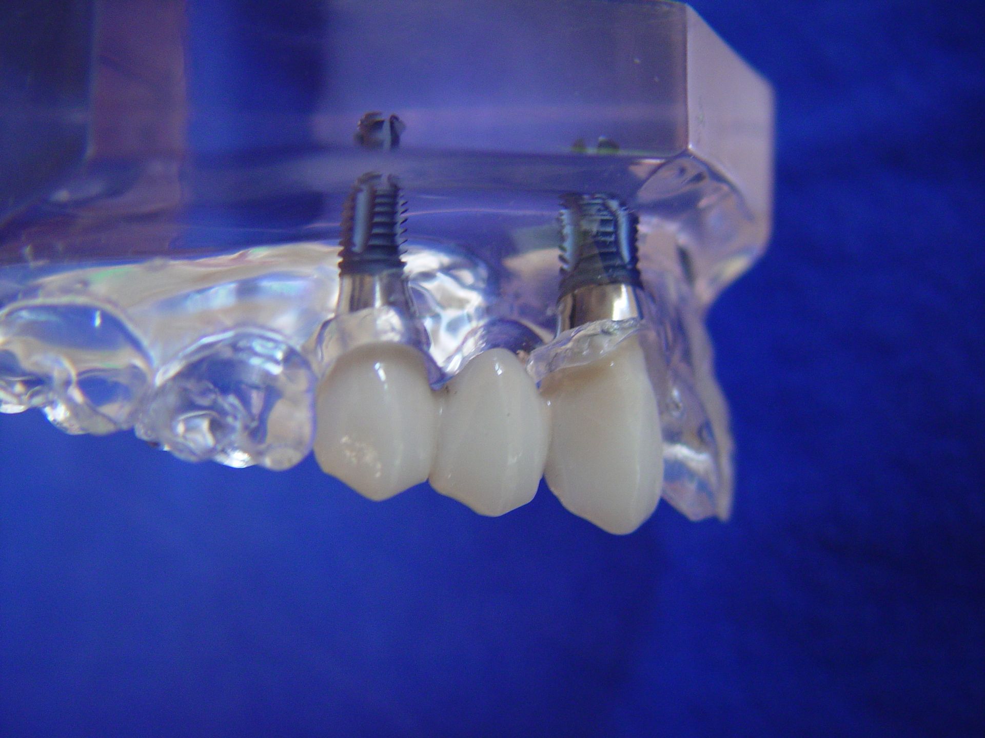 Oralchirurgie & Implantologie Bern