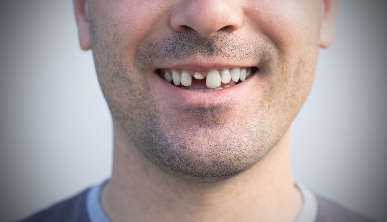 A dentist is holding a model of a dental implant in his hands.