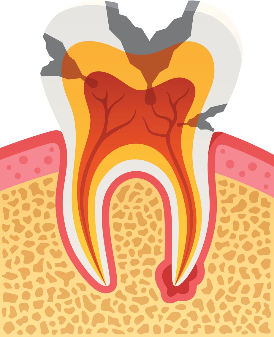 A diagram of a tooth with a hole in it.