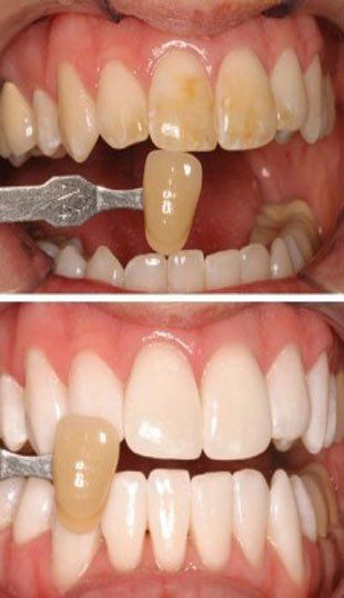 After Teeth Cleaning — Terre Haute, IN — Roshel Family Dentistry