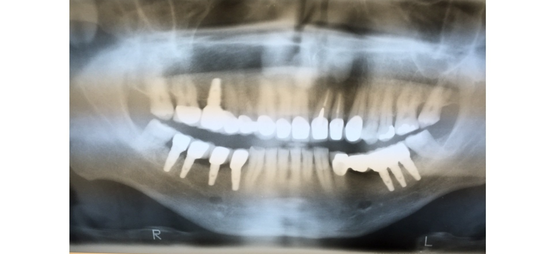 teeth xrays
