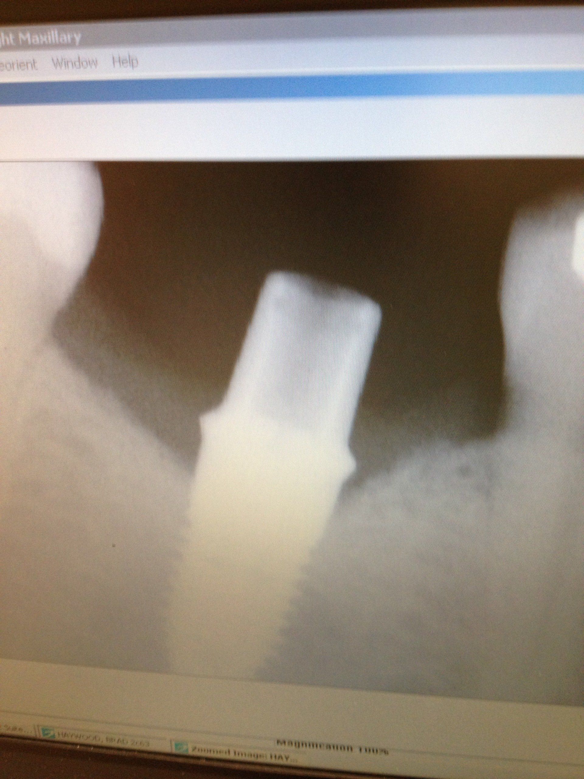 tooth xray