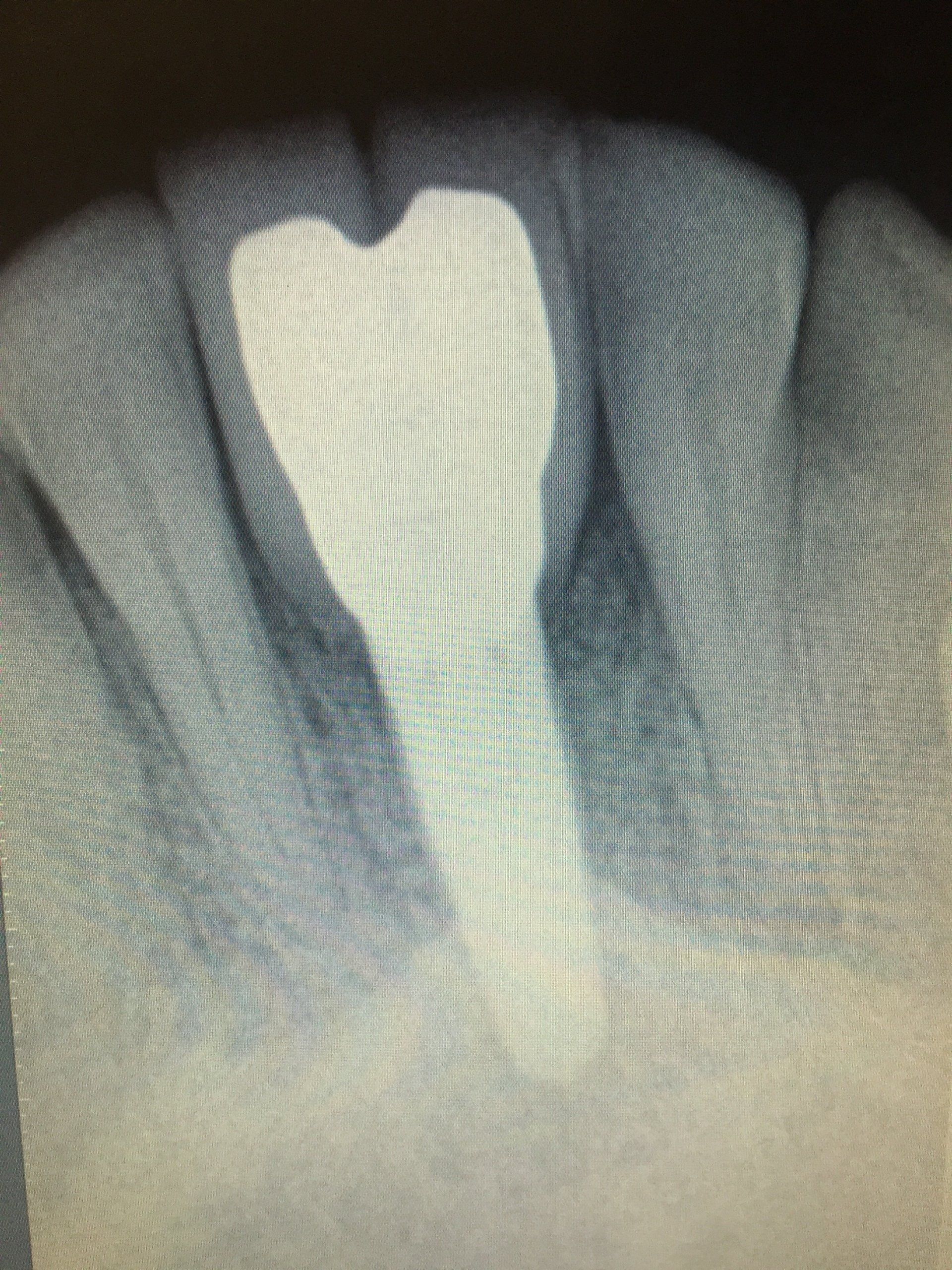 tooth xray