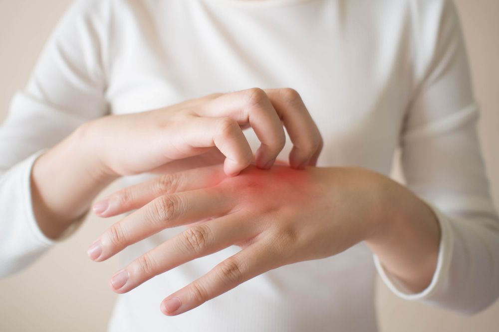 a woman is scratching her hand with a red spot on it — Herbalism & Naturopathy on Tweed Heads NSW