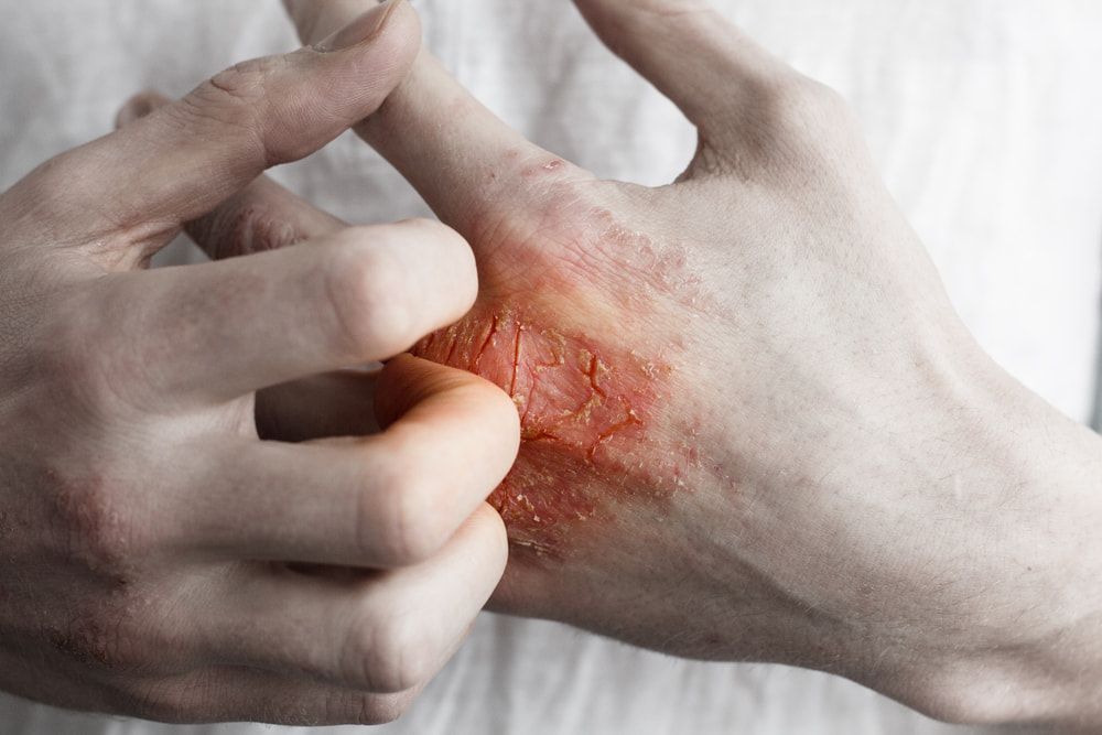 Person with a skin rash on their hand is scratching it — Herbalism & Naturopathy on the Gold Coast QLD