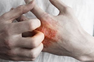 Person With A Skin Rash On Their Hand Is Scratching It — Naturopath Australia In Mermaid Beach, QLD