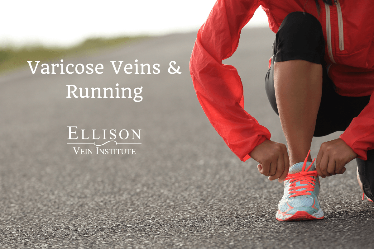 Varicose Veins and Running