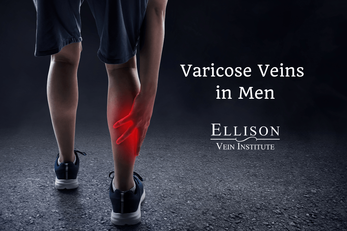 Varicose Veins and Running
