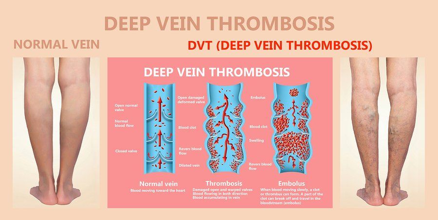 bigstock Deep Vein Thrombosis Or Blood 285648982 960w