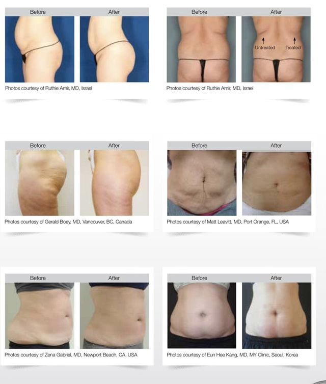 Tummy Tuck Before and After Pictures Case 16, Idaho Falls, ID