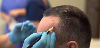 Hair Transplant Palm Springs – Advanced FUE Hair Restoration