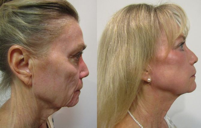 CO2 Laser with Full Fat Package with Non-Incision Side View — Dearborn, MI — Masri Clinic