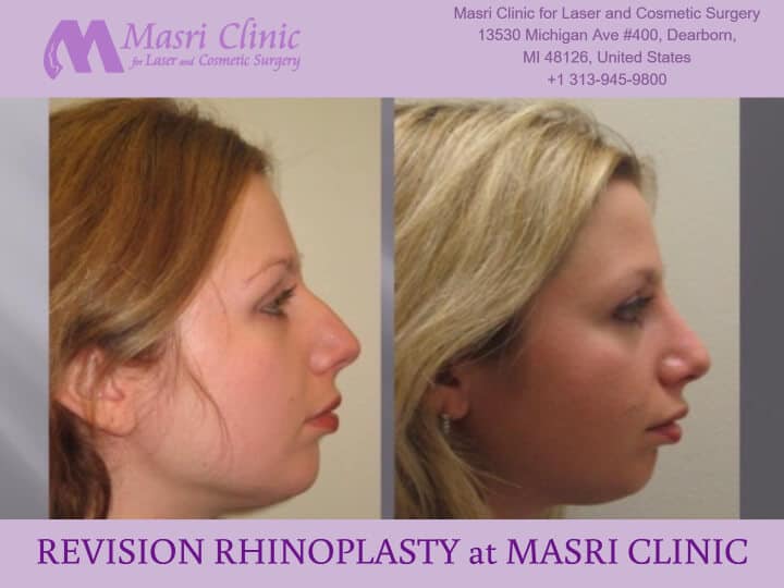 Revision Rhinoplasty — Dearborn, MI — Masri Clinic