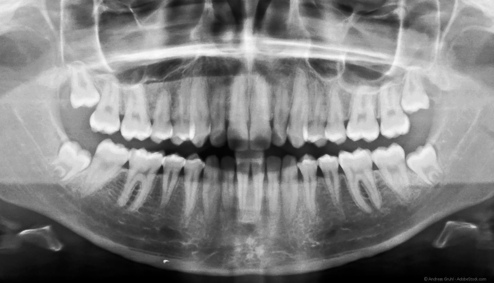 Oralchirurgie Korbach: Weisheitszahn-Entfernung