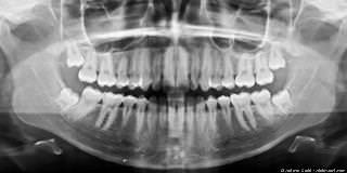 Oralchirurgie Korbach: Weisheitszahn-Entfernung und mehr