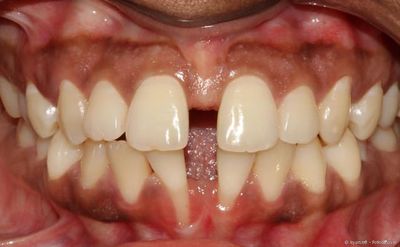 Sog. Diastema (Zahnlücke) bei stark ausgeprägtem Lippenband