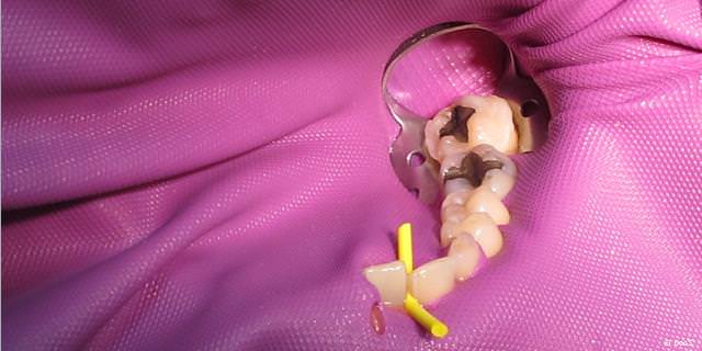 Amalgamentfernung Korbach