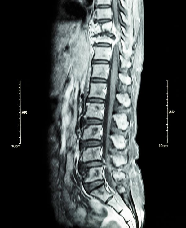 Wirbelkörperfraktur mit Kompression des Rückenmarks durch eine Prostatakrebsmetastase
