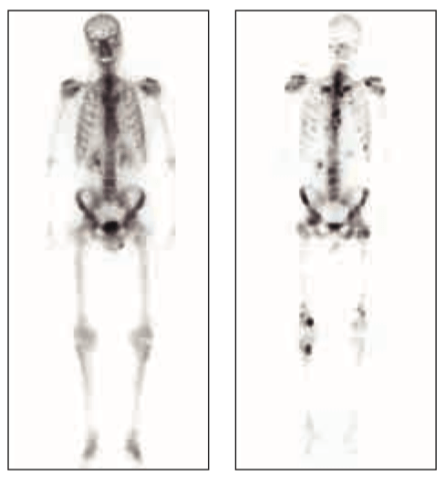 Knochenszintigrafie bei Prostatakrebs: links degenerative Veränderungen des Skelettsystemes rechts: multiple Knochenmetastasen