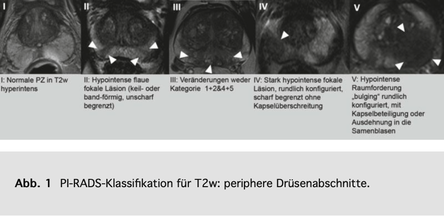 Pirads Klassifikation für periphere Drüsenabschnitte in T2-Wichtung (aus Röthke 2013)