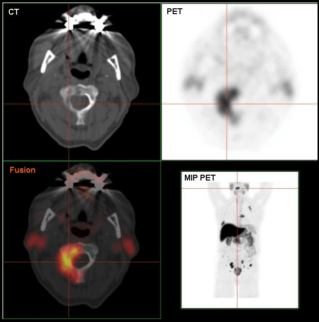 F-18 Cholin-PET/CT einer Metastase im 2. Halswirbelkörper - Quelle: Wikipedia (User:Hg6996)