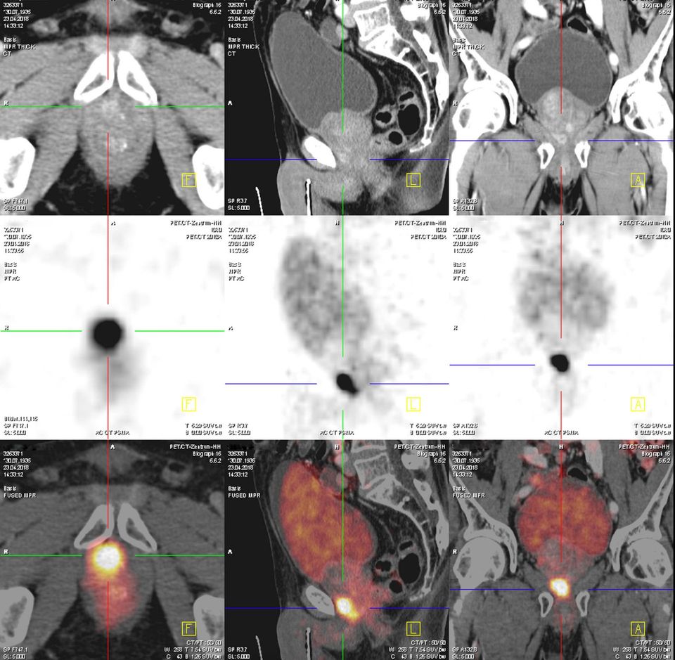 PSMA-PET/CT Fokaler Prostatakrebs